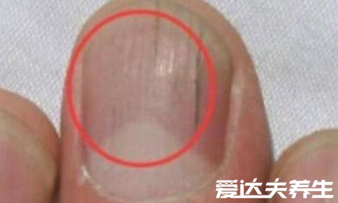 指甲有竖纹是身体的什么信号，可能是身体健康出现了问题