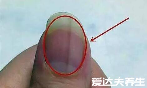 指甲有竖纹是身体的什么信号，可能是身体健康出现了问题
