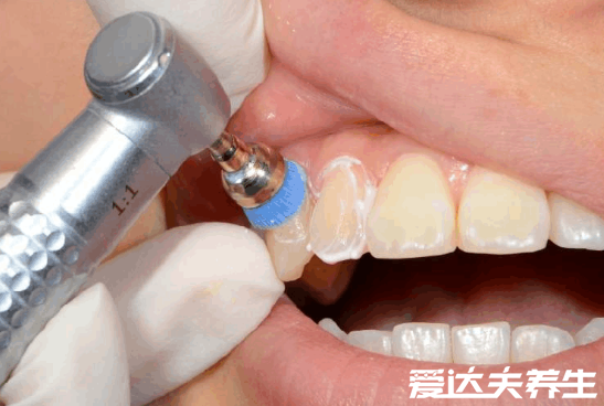 洗牙对牙齿有伤害吗，为什么医生不推荐洗牙(这四类人要注意)
