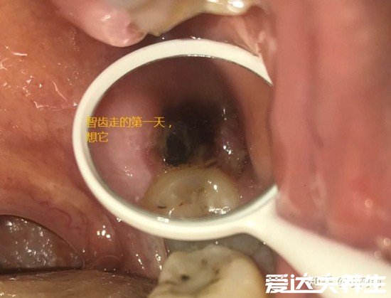超详细拔牙后窟窿恢复图，保持口腔卫生3个月就能完全恢复