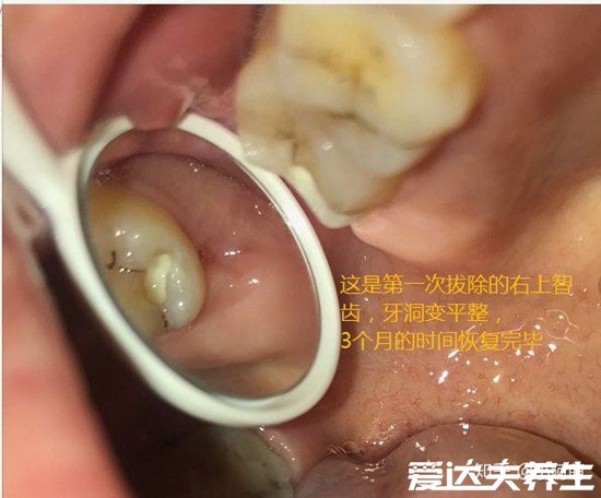 超详细拔牙后窟窿恢复图，保持口腔卫生3个月就能完全恢复