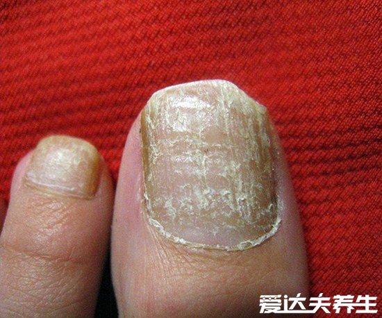 不同病症最轻微的灰指甲图片，指甲内出现白色斑点就赶紧去治