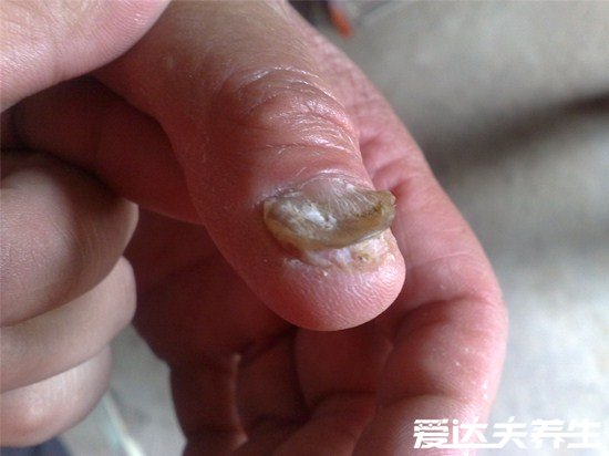 不同病症最轻微的灰指甲图片，指甲内出现白色斑点就赶紧去治