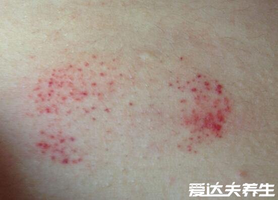 白血病初期小红点图片，千万不要被皮肤病的表象所蒙骗