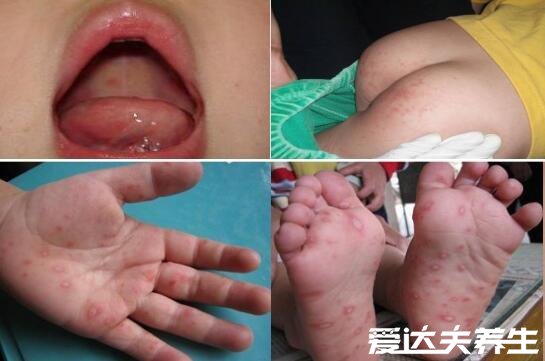 小儿手足口病最早期图片，遇到重症请立即就医否则有生命威胁