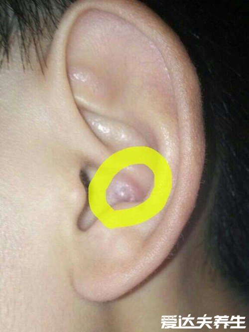 耳垂里面长了个硬疙瘩是什么原因，内分泌引起的良性粉瘤