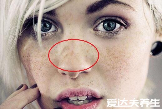 女人长斑的位置图解，长在眼睛周围要注意可能是肾虚了