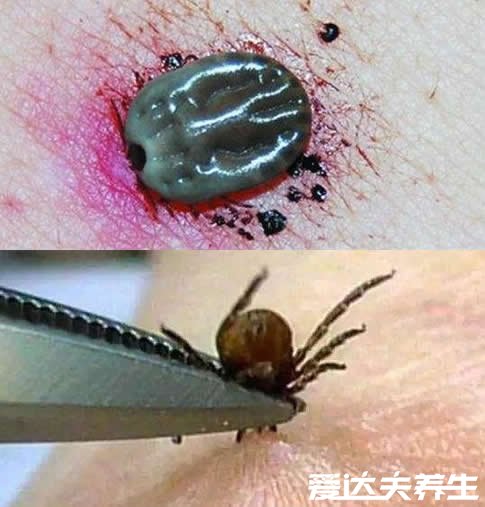 真实的蜱虫咬人后的伤口图，不小心处理也容易要人命