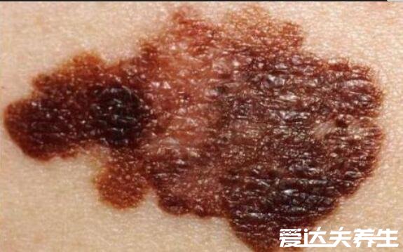 真实的皮肤癌早期症状图片，出现这些症状一定要赶紧就医