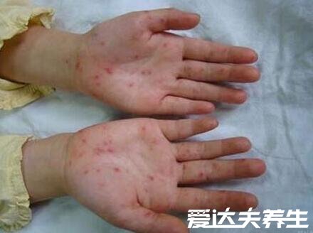 小儿手足口病最早期图片，出现红色丘疹时就需要注意了