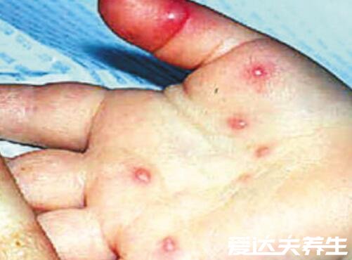 手足口病症状初期图片，如有相似尽快就医(附治疗事项)