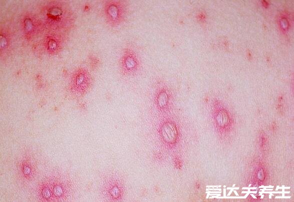 水痘早期图片大全，水痘刚开始的样子是红点很快转为水泡