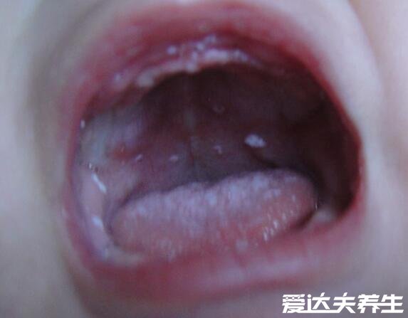 婴儿鹅口疮最早期图片，雪口病与奶苔不同需尽早治疗