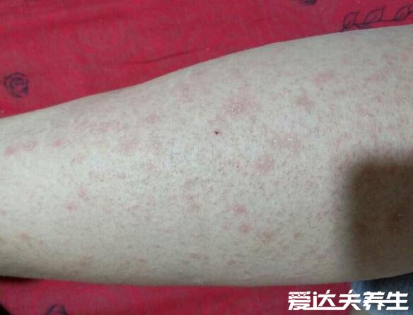 玫瑰糠疹怎么引起的会传染吗，不会传染但病因不详(图片)