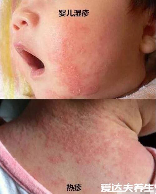 湿疹和热疹的区别图片，一眼就看出症状其实有明显不同