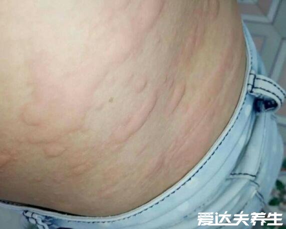 多种荨麻疹初期症状图片，突发形态不一的风团并伴随剧烈瘙痒