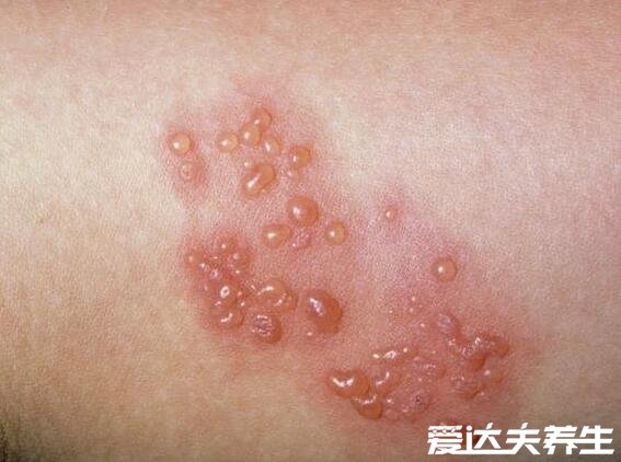 早期带状疱疹图片，一侧发病的带状水疱要与全身性水痘区分开