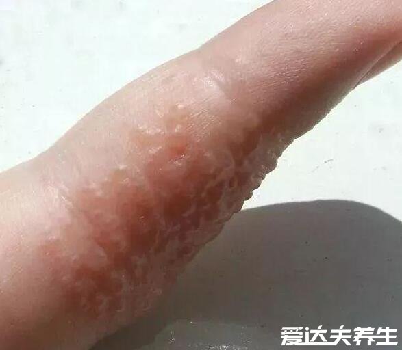 汗疱疹图片及症状，手足对称出现小水泡并伴随剧烈瘙痒