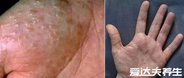 汗疱疹图片及症状，手足对称出现小水泡并伴随剧烈瘙痒
