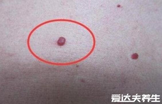 艾滋病最初皮疹图片及症状，出现略微凸起小红点和淋巴结肿大