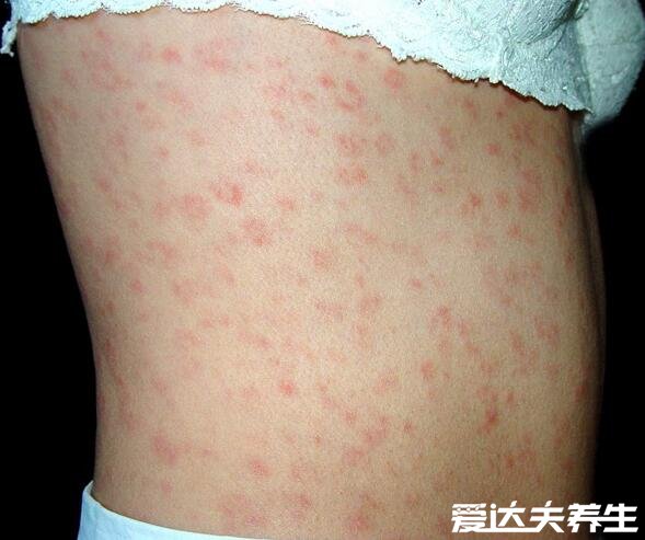梅毒疹图片及症状，身上出现咖啡色皮疹并蔓延至全身