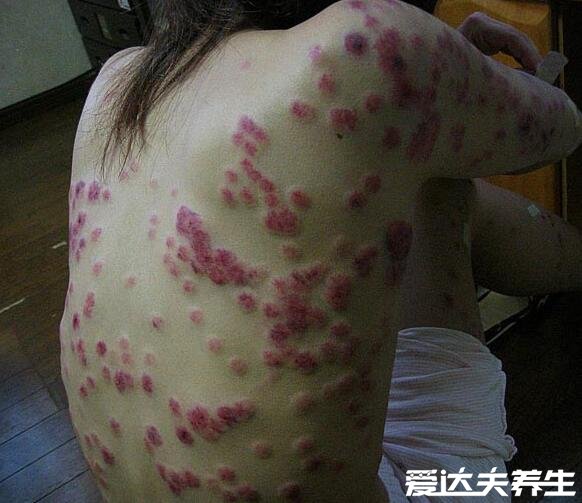 梅毒疹图片及症状，身上出现咖啡色皮疹并蔓延至全身