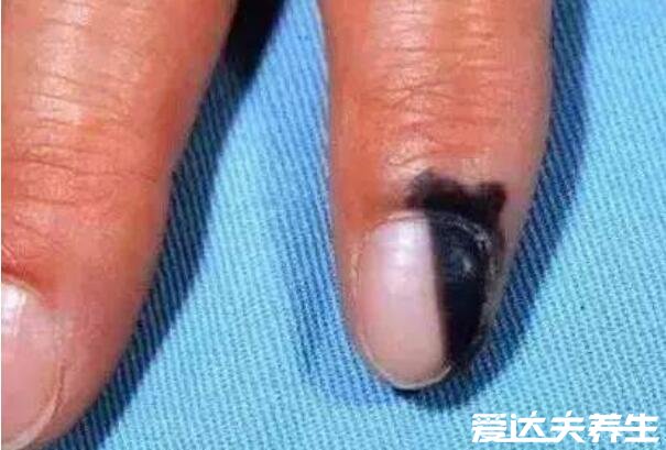 容易癌变的痣的图片，指甲长痣/胎记/受伤处长出的痣都需要注意了