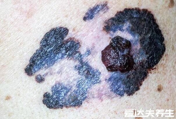 容易癌变的痣的图片，指甲长痣/胎记/受伤处长出的痣都需要注意了
