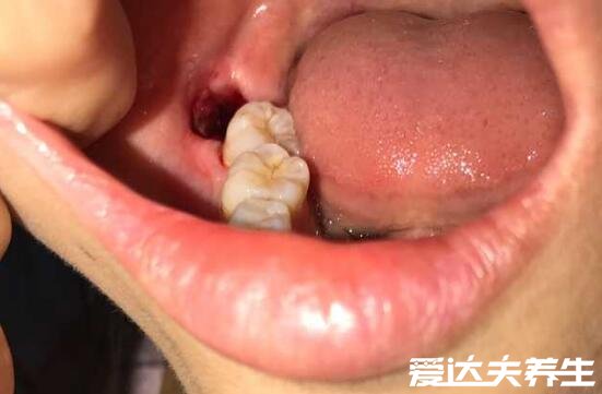 拔牙后窟窿恢复图，注意口腔清洁禁食辛辣(三个月便可以恢复)