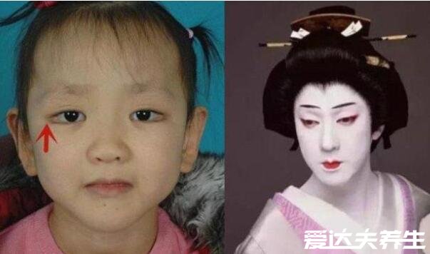 歌舞伎面谱综合征，宝宝的容貌非常漂亮且有3点异常时需要注意