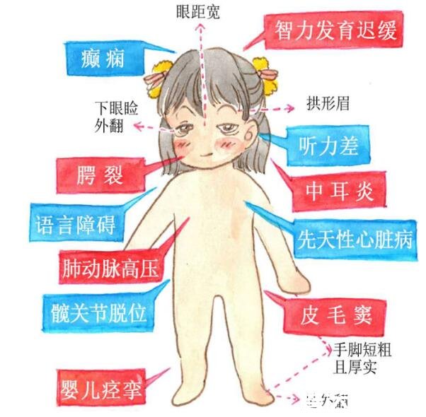 歌舞伎面谱综合征，宝宝的容貌非常漂亮且有3点异常时需要注意