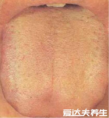 超详细胃癌早期舌头图片，舌苔发黑无知觉一定要引起重视