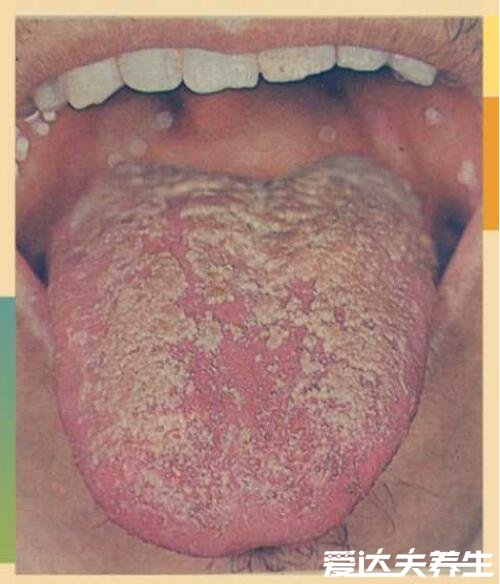 早期胃癌就会出现一些症状,比如舌头发黑舌苔变成暗红色,一点要尽早去