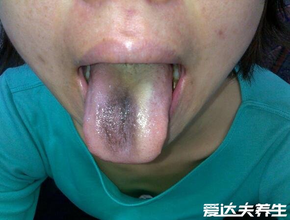 胃癌早期舌头图片，舌头变黑舌苔发黄厚重的可能患胃癌