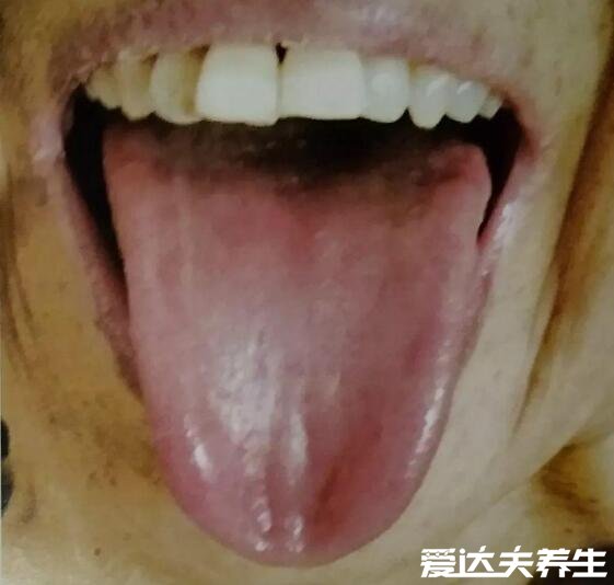 胃癌早期舌头图片,舌头变黑舌苔发黄厚重的可能患胃癌