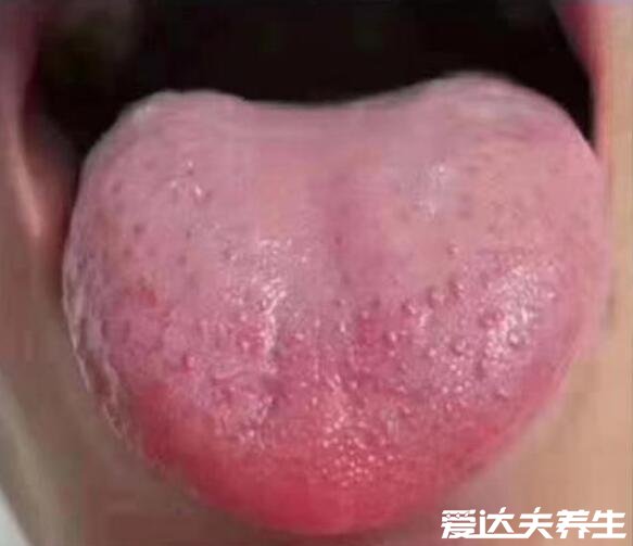胃癌早期舌头图片，舌头变黑舌苔发黄厚重的可能患胃癌