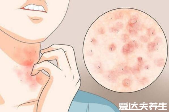 螨虫叮咬后的症状图，青春痘酒糟鼻皮疹多是由螨虫引起的