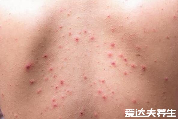 螨虫叮咬后的症状图，青春痘酒糟鼻皮疹多是由螨虫引起的