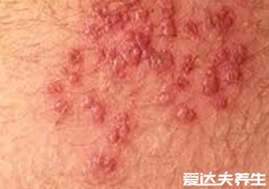 艾滋病初期小红点照片，与带症状疱疹十分相似(密集恐惧症勿入)