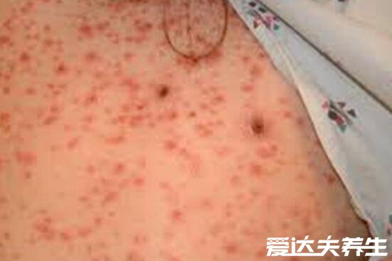 艾滋病初期小红点照片，与带症状疱疹十分相似(密集恐惧症勿入)