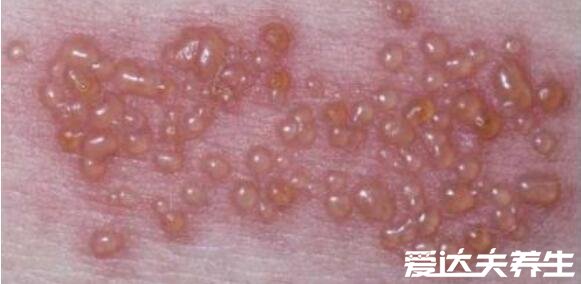 艾滋病初期手上水泡图片，皮肤黏膜出现炎症或疱疹时需要注意