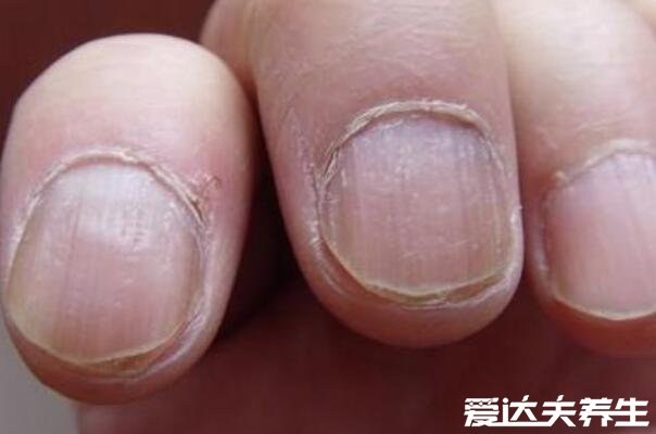 最轻微的灰指甲图片，难以根治尽量在早期治疗