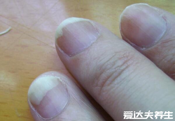 最轻微的灰指甲图片，难以根治尽量在早期治疗