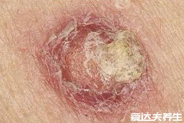 皮肤癌早期症状图片，出现不正常的痣/新生突起物要警惕