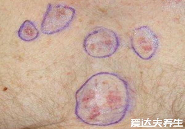 皮肤癌早期症状图片，出现不正常的痣/新生突起物要警惕