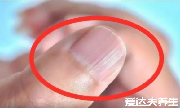 指甲有竖纹是身体的什么信号，过度劳累或肝功能下降导致中毒
