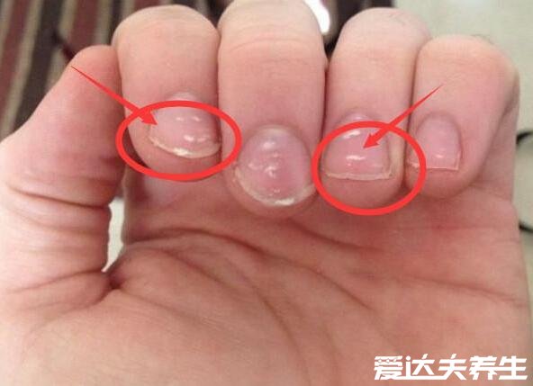 指甲有竖纹是身体的什么信号，过度劳累或肝功能下降导致中毒