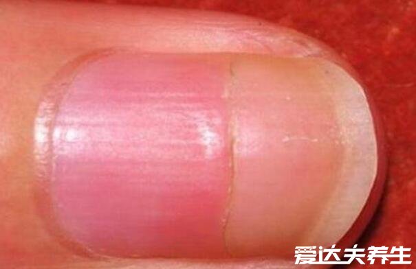 指甲竖纹多是癌症的可能性不大，多为正常现象或亚健康状态