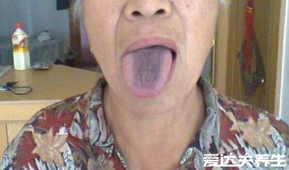 胃癌早期舌头图片，舌苔发黑舌边有红刺一定要注意
