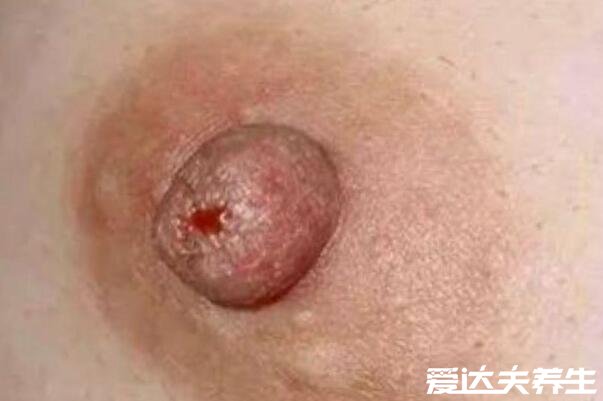 乳腺癌早期症状图片，乳房出现凹陷/乳头溢液等症状需尽快治疗